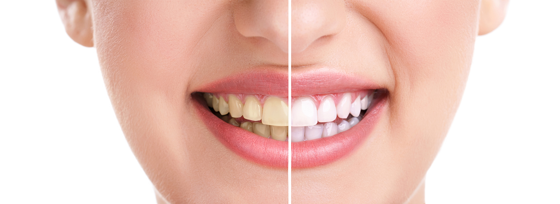 Teeth Whitening Dentist 11368